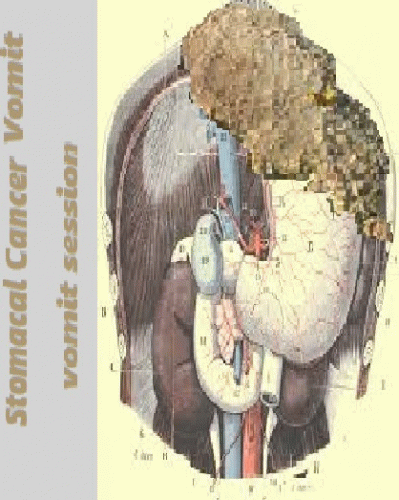 Stomacal Cancer Vomit : Vomit Session